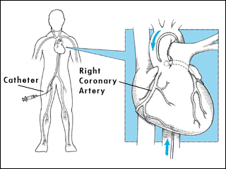 Apologise, can shaved for heart cath Good when shaved for heart cath